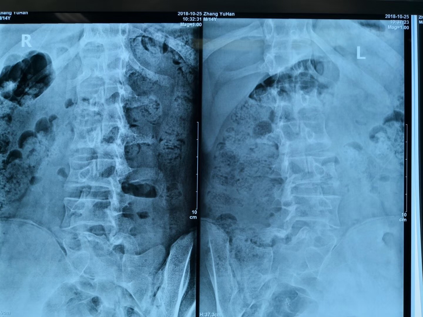 诊断为腰椎滑脱症(腰5椎体双侧椎弓峡部裂,腰5椎体前滑脱ii度),考虑系