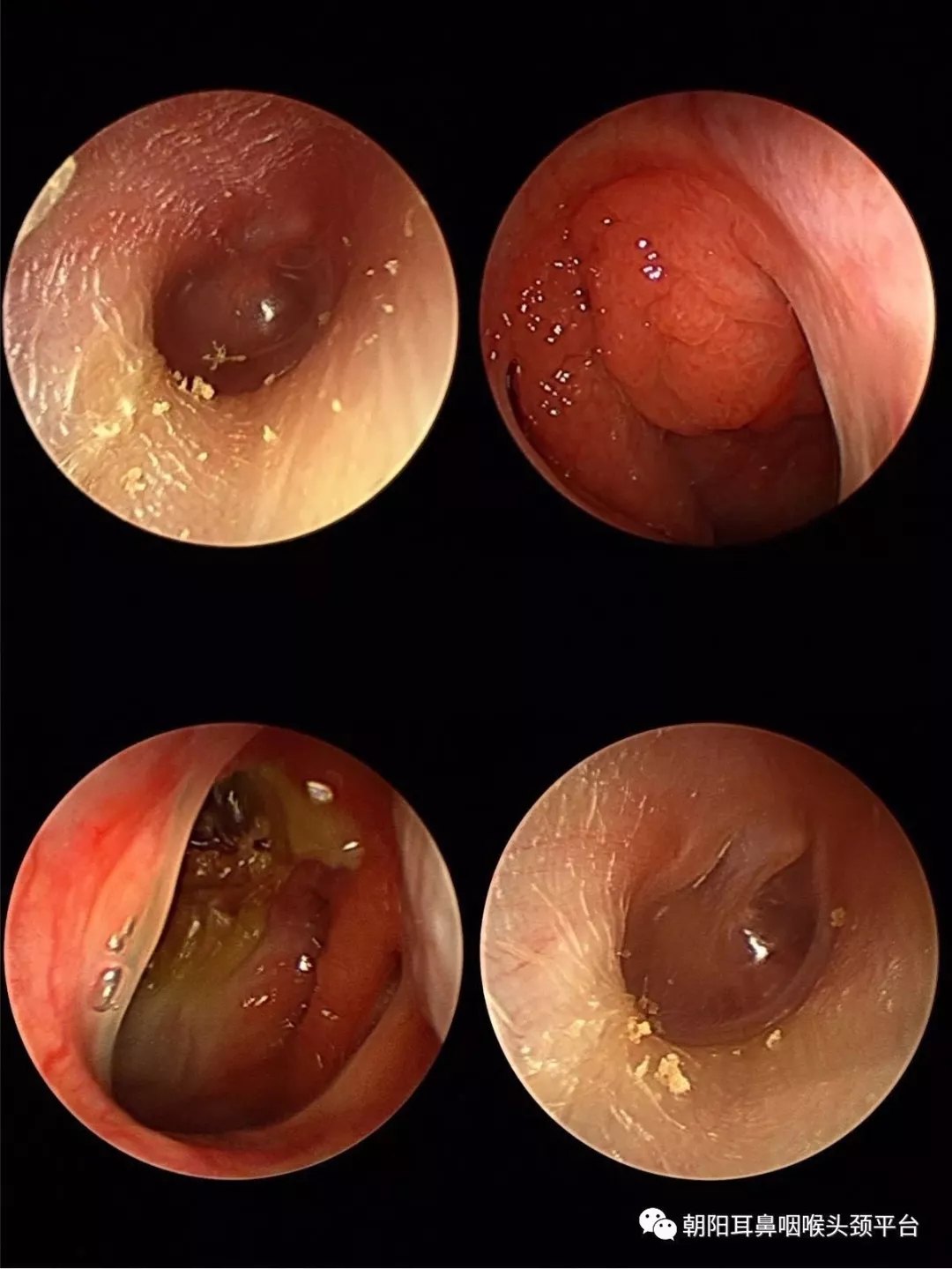 若有鼻腔 ,鼻咽部或中耳细菌感染,需应用抗生素治疗.