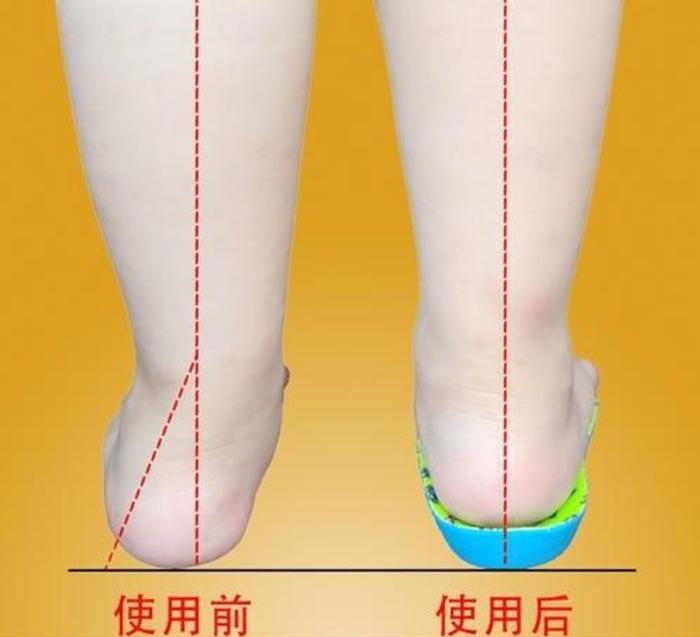 儿童扁平外翻足