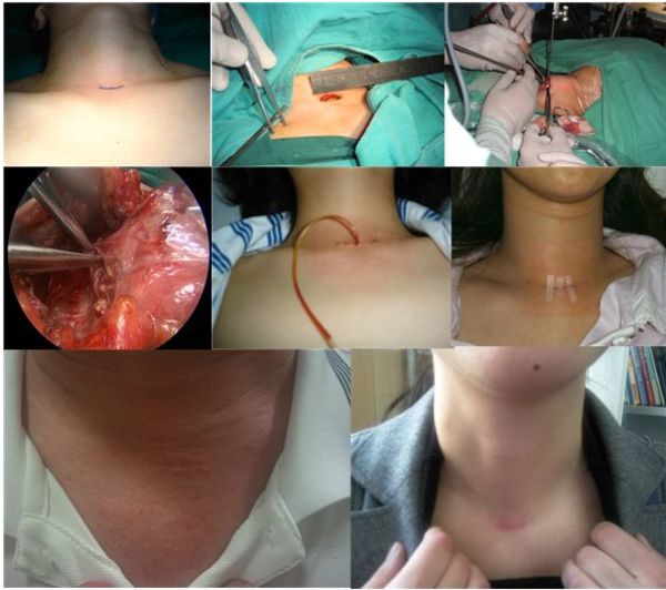 腔镜辅助下颈部小切口微创甲状腺手术