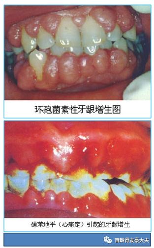 肾移植者牙龈增生怎么办?出现牙周炎或牙周脓肿时怎么办