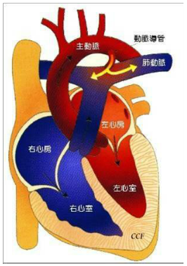 左右肺动脉交叉图片