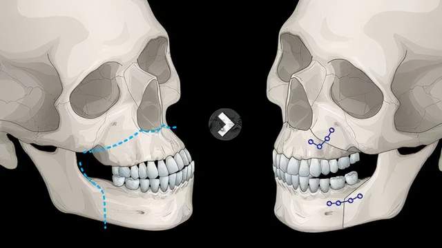 颌骨发育有哪些问题如何矫正治疗