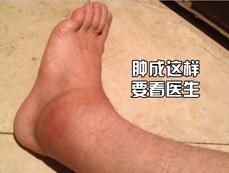 原创脚踝扭伤成习惯可就真的伤不起