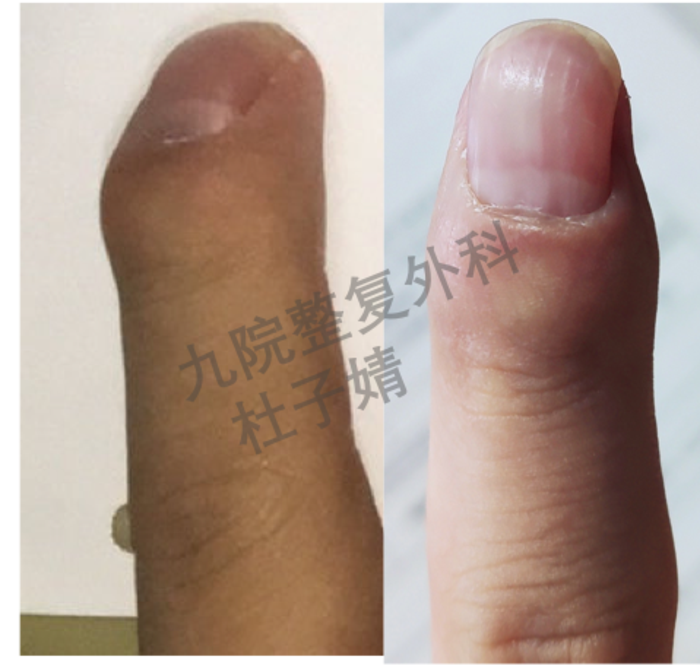 小指畸形kirners畸形和侧偏畸形