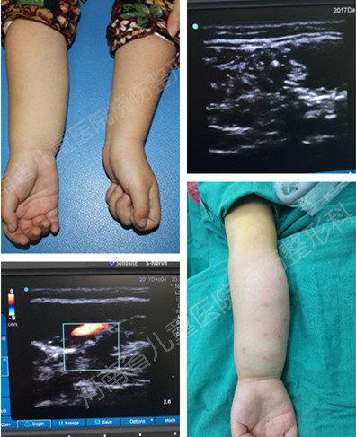 瞧这可怜的小胖胳膊原来是静脉畸形