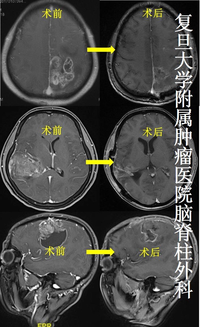 神经导航下脑立体定向活检术