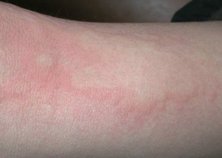 穿戴口罩手套护目镜等防护装置所致皮肤病的防治