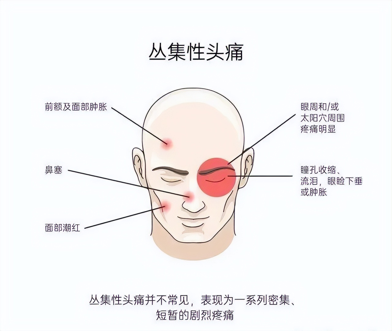 痛入脑髓的丛集性头痛如何拯救