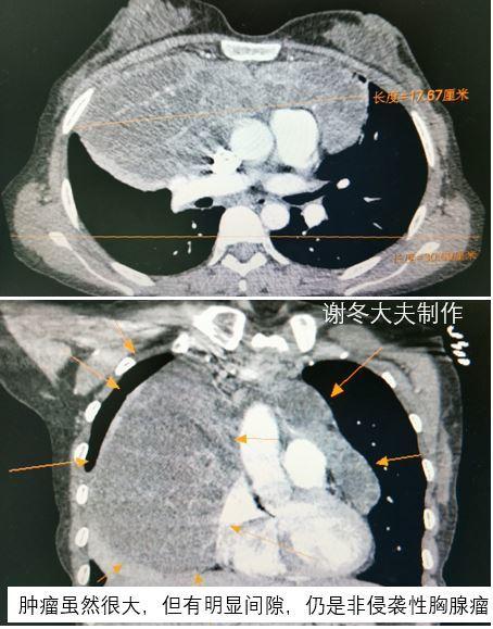 胸腺瘤生长速度图片