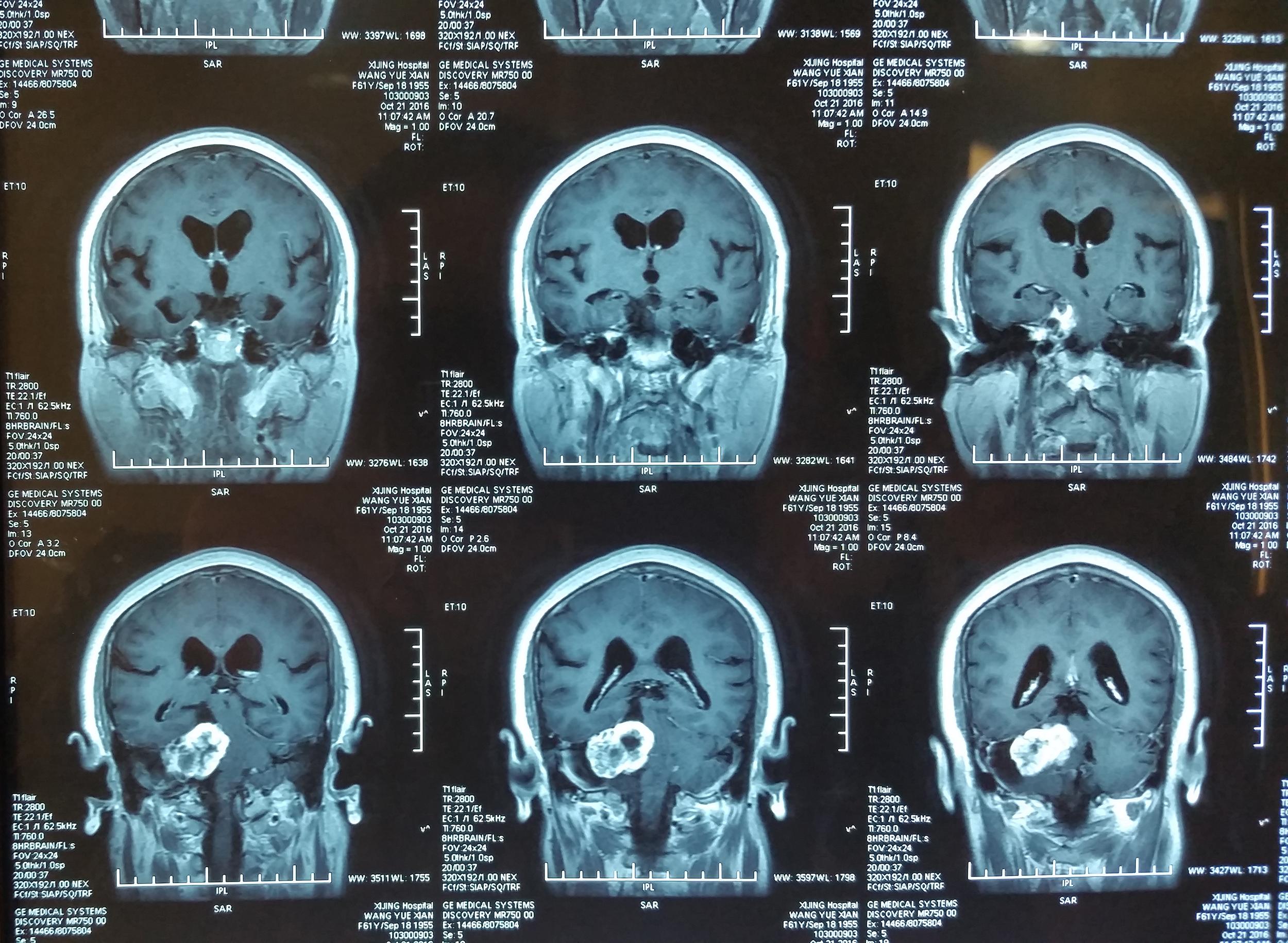 桥小脑角区脑膜瘤-磁共振成像读片中枢神经-医学
