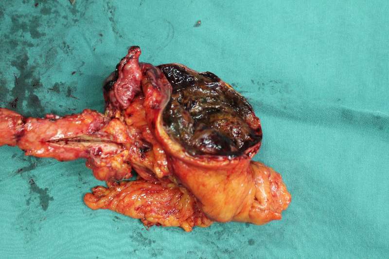 湖北女孩胃疼吃药不管用一检查竟患胰腺肿瘤