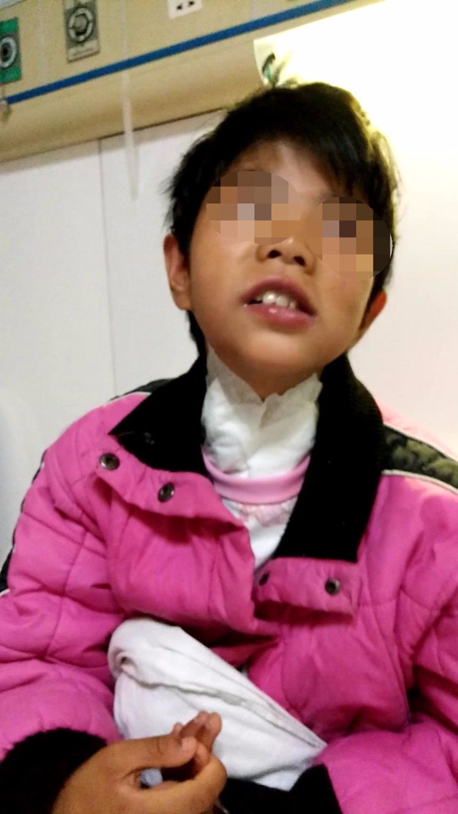 脑瘫孩子流口水说话不清如何治疗