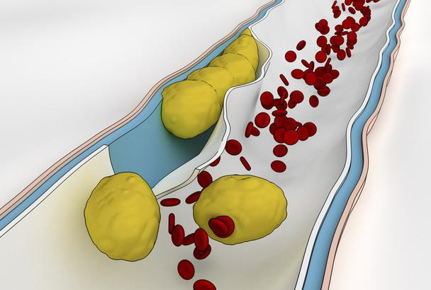 我国25的人死于心血管疾病医生4事比烟酒伤血管劝你尽早改