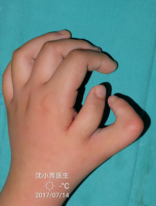 桡侧多指复拇畸形的常见分型及治疗