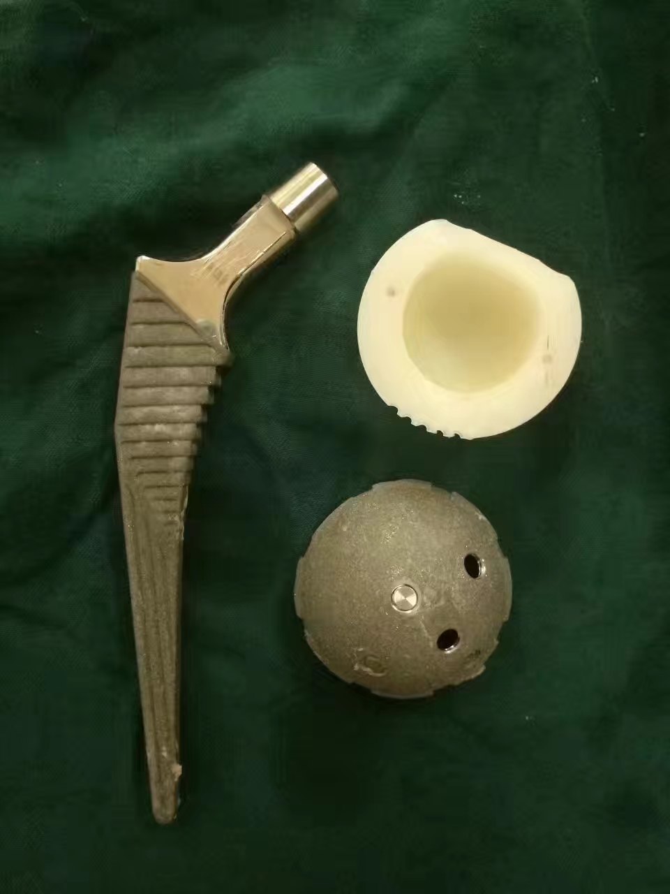 病例3 双髋关节置换术后,一侧感染,窦道流脓,第一次取出假体,旷置