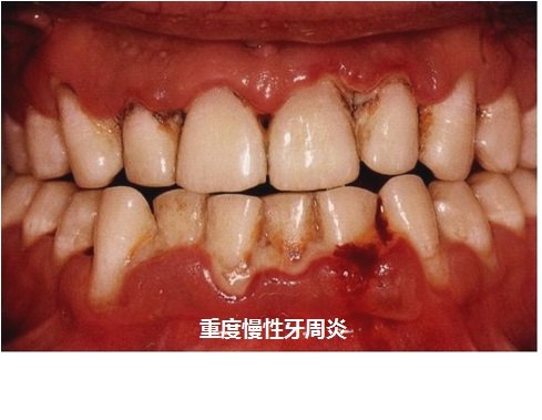 牙周炎的四大症状图片