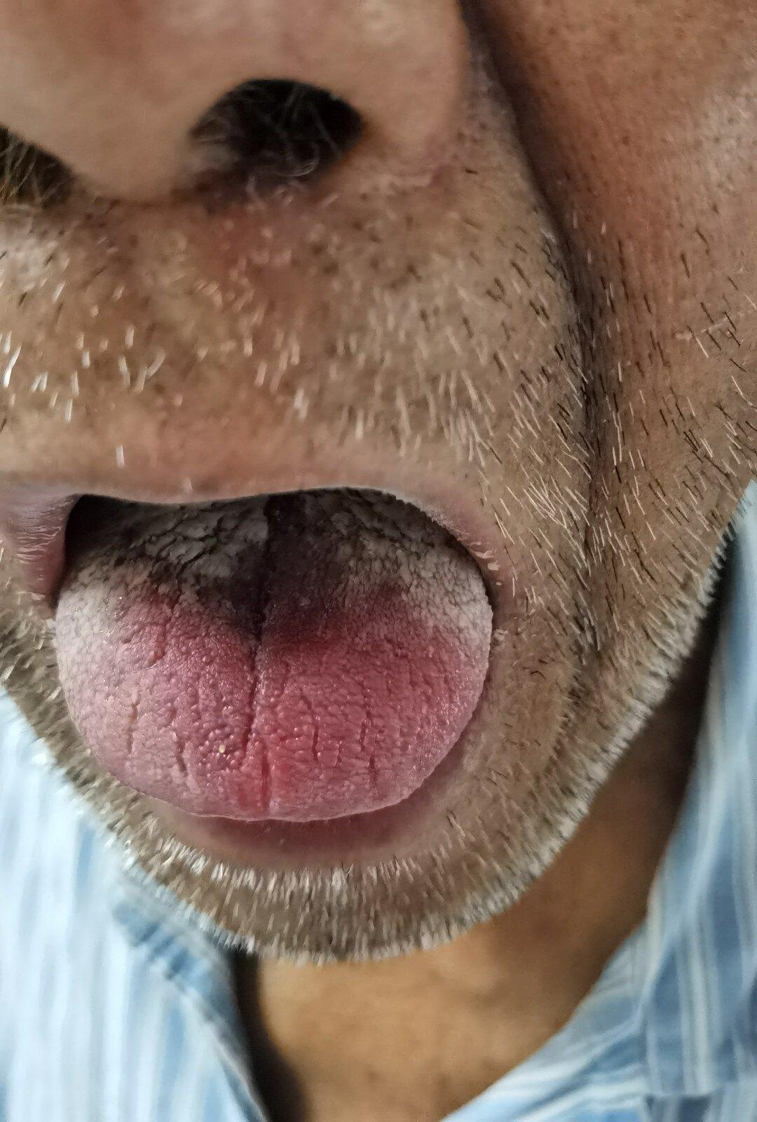 中医药配合化疗治疗男性中晚期肺鳞癌病案1