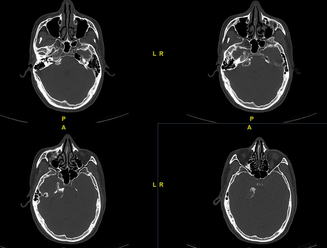 术前头颅ct可见右侧岩尖部高密度影复旦大学附属肿瘤医院神经外科郝斌
