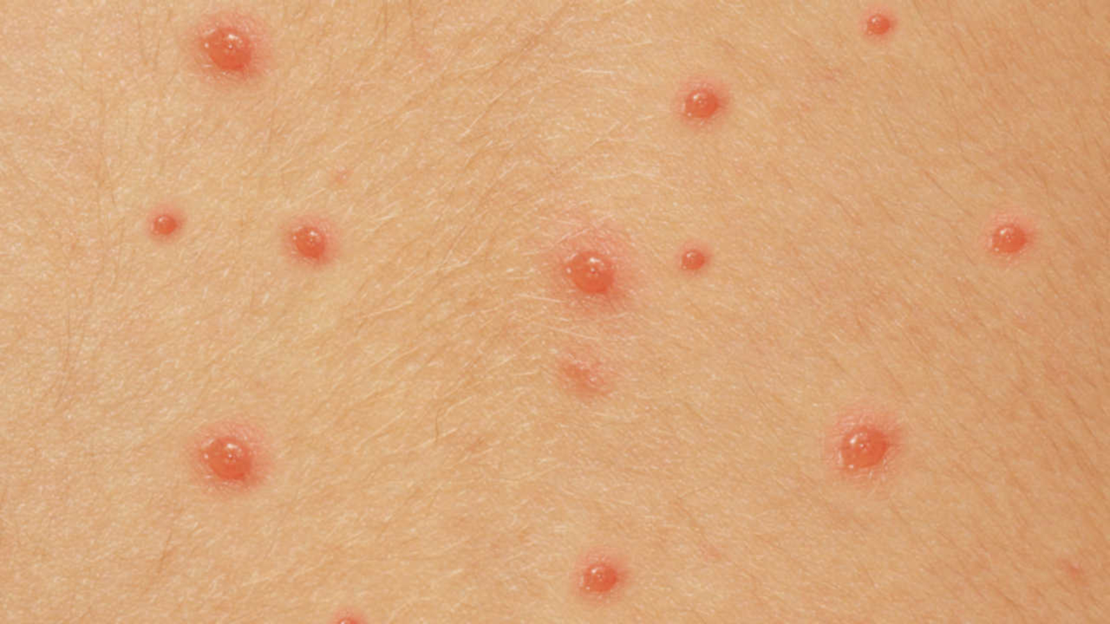 水痘除了皮疹之外,单核细胞增多症的其它症状,包括头痛,发热,咽喉痛和