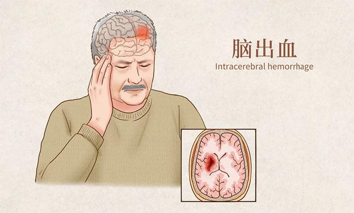 五旬男子高血壓導致腦幹出血術後昏迷50余天高壓氧治療助他成功促醒