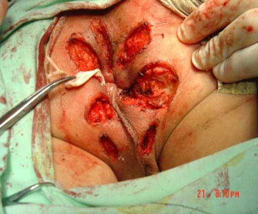 肛腺全切除术治疗复杂性肛瘘_黄平医生文章_江苏省人民医院-微医